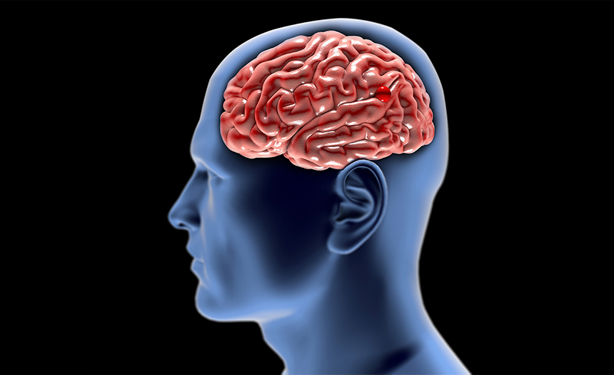 Aneurisma cerebral: una rara y peligrosa enfermedad