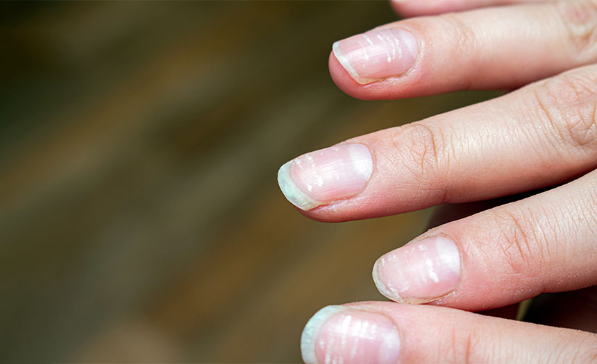 La apariencia de tus uñas puede dar indicios de una enfermedad grave
